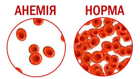 анемія симптоми