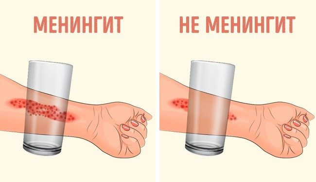 менінгіт це