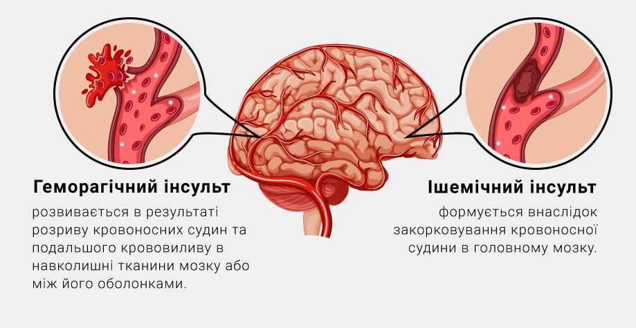 ішемічний інсульт