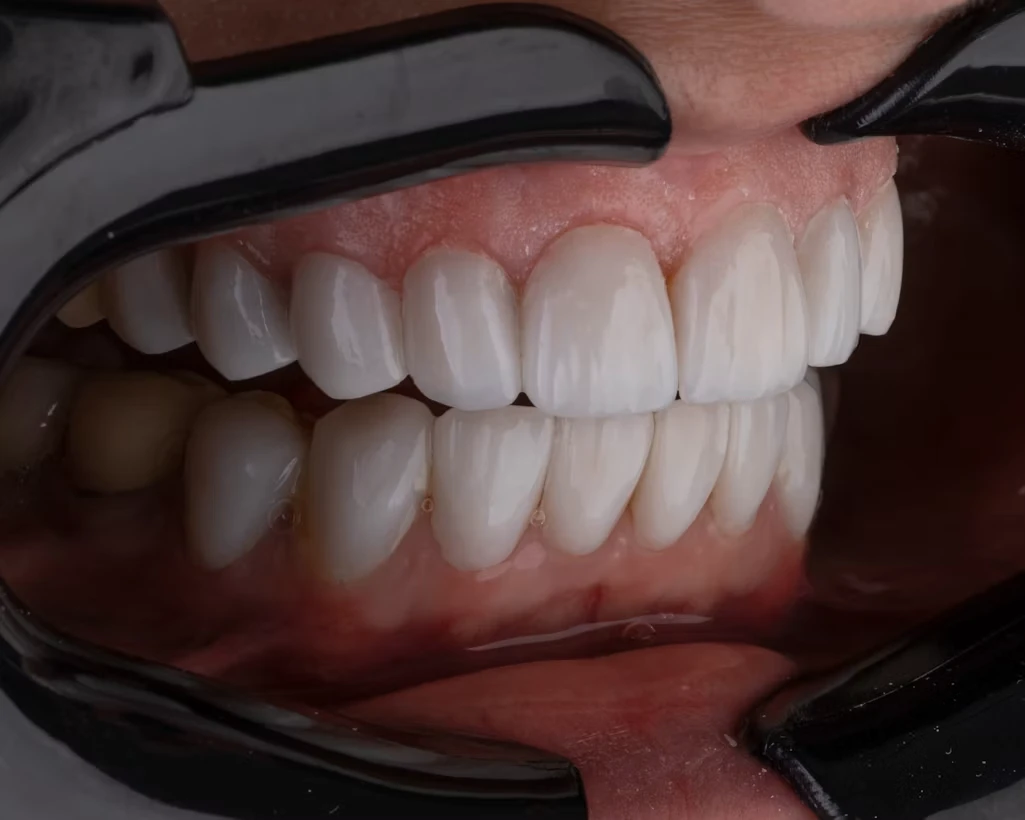 Коли домашні засоби для відбілювання зубів безсилі